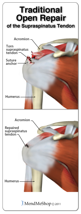 Traditional open repair surgery to repair the supraspinatus tendon of the rotator cuff.