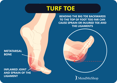 turf toe ligament sprain big toe