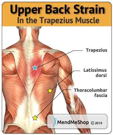 Trapezius muscle strain