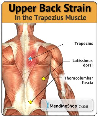 trapezius back muscle strain
