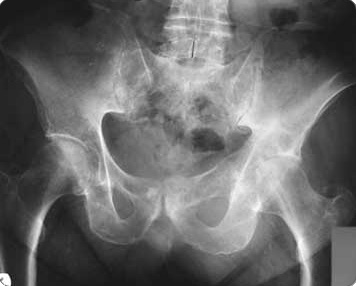 X-RAY of pelvic region including iliopsoas