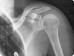 Shoulder X-RAY highlights bone spurs, acromion abnormalities or calcification