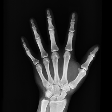 bones of the wrist X-RAY