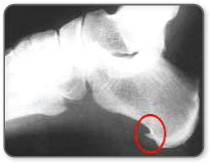What a heel spur looks like
