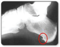 an x-ray of a foot with a heel spur